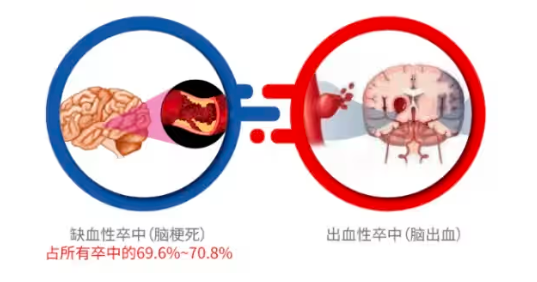 脑卒中与缺血预适应训练